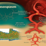 TCD and Vasospasm (6 credits-CME) not available yet